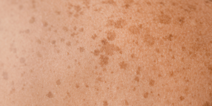 Spots 101: Your Ultimate Guide to Differentiating Pigmentation