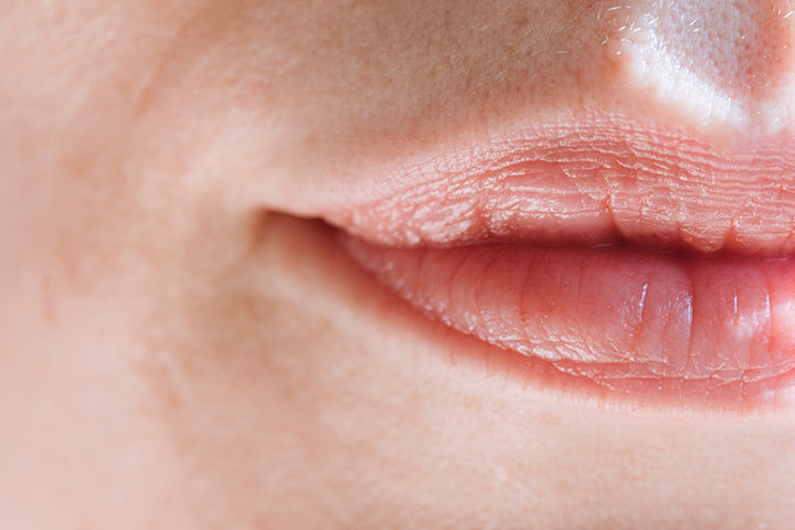 Lines and Wrinkles on the Upper Lip and Around the Mouth Explained – Caci