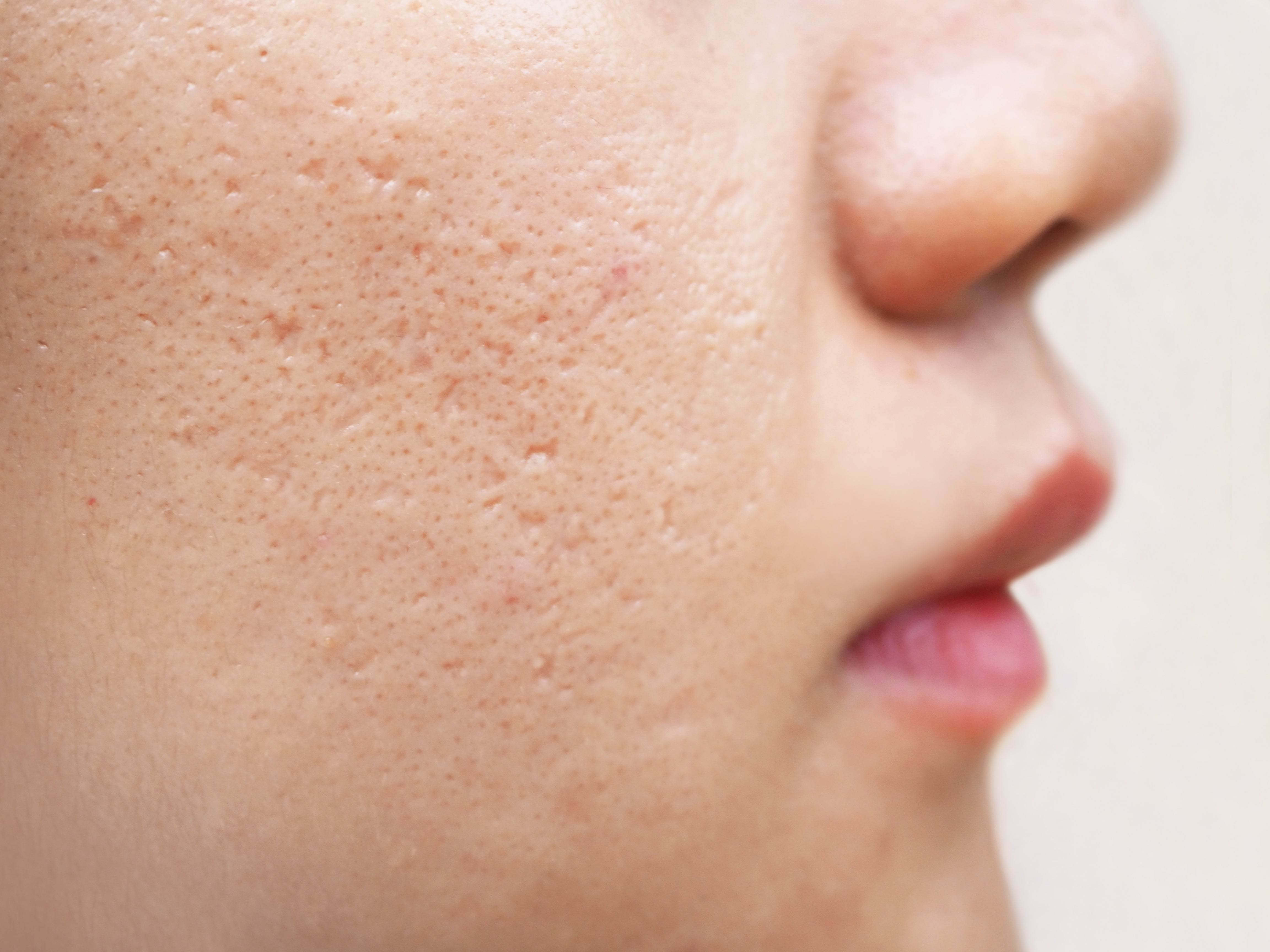 acne dark spots on face