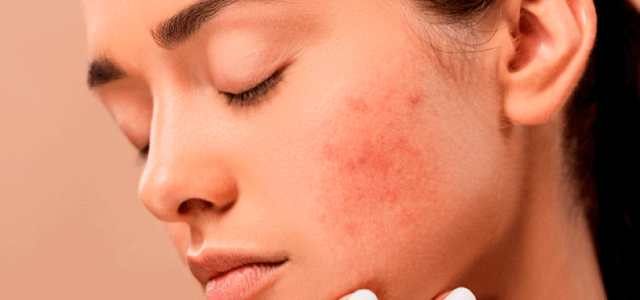 How to prevent blemishes (and what to do when you start to break out)