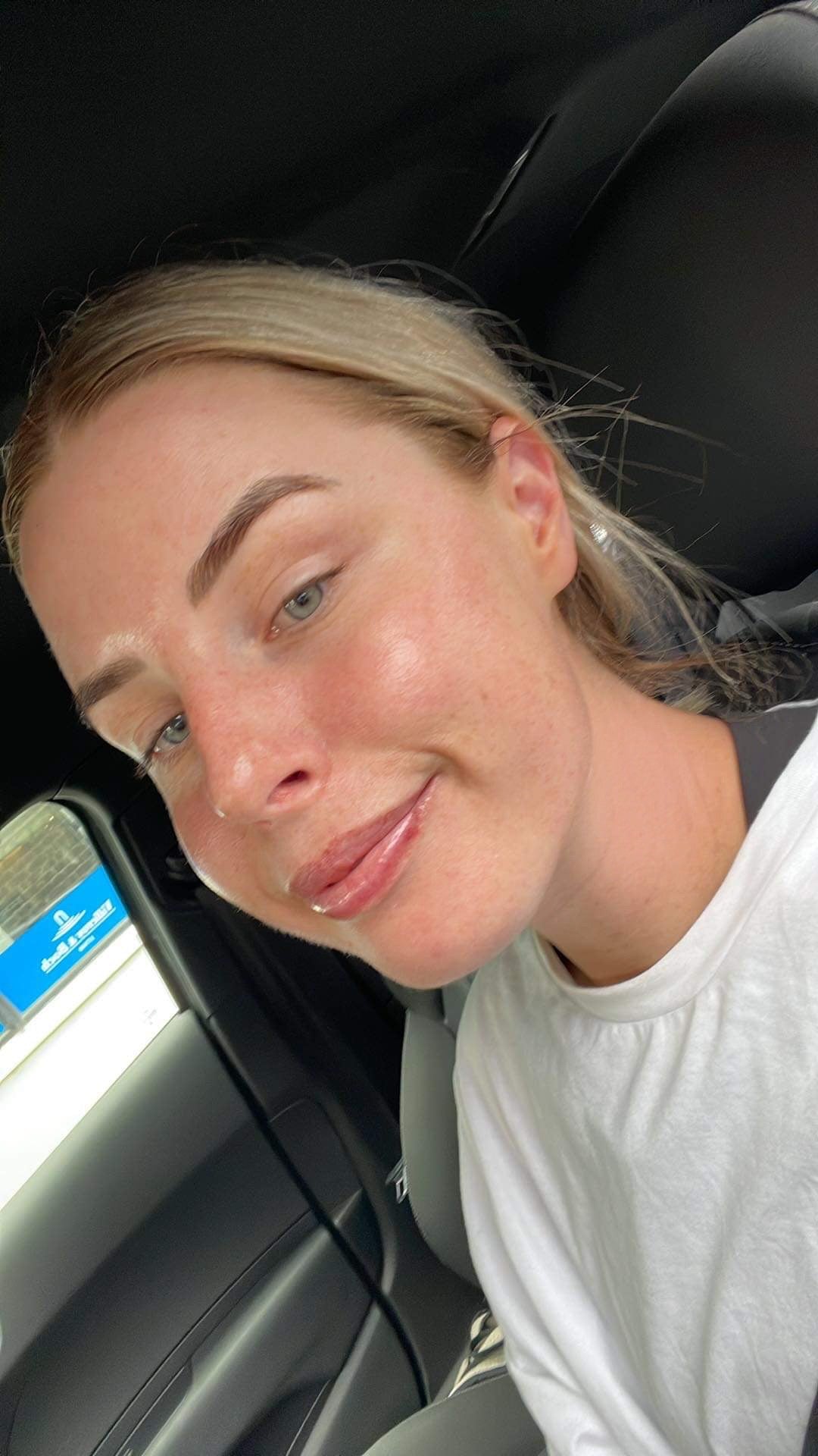 Kate Milliken: I tried the Caci Laser Facial..