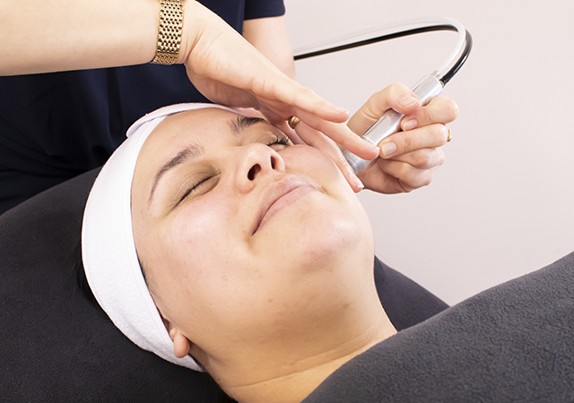 Can Microdermabrasion help improve acne scars?