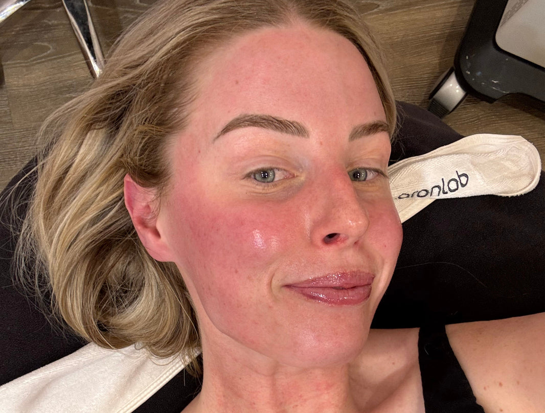 Follow me on my Caci Signature Laser Facial skin journey