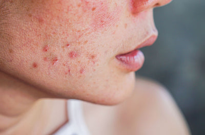 Skin 101: 10 reasons why you shouldn't pop your pimple (and what you should do instead)