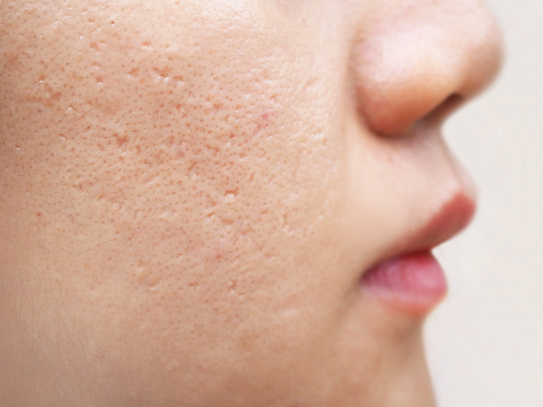 Acne Scar Removal Malaysia