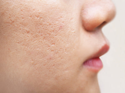 Acne Scar Treatments that Actually Work