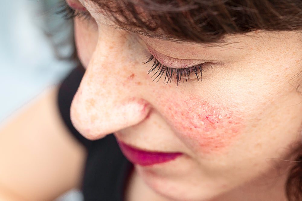 What causes rosacea? Your skin redness questions answered