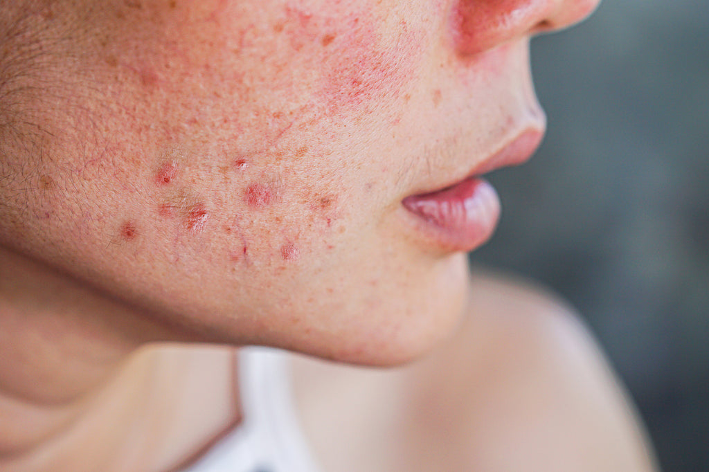Dry Skin But Breaking Out? Here's What You Need To Know