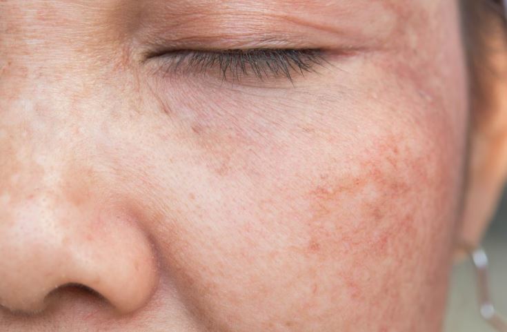 Uneven skin tone? Here’s what you should know