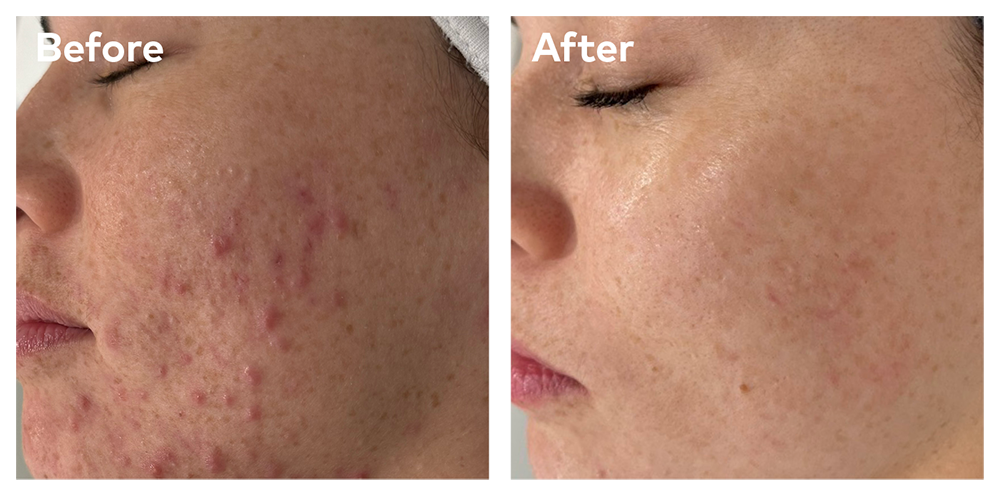 Blemish Control Facial blemish-control-facial