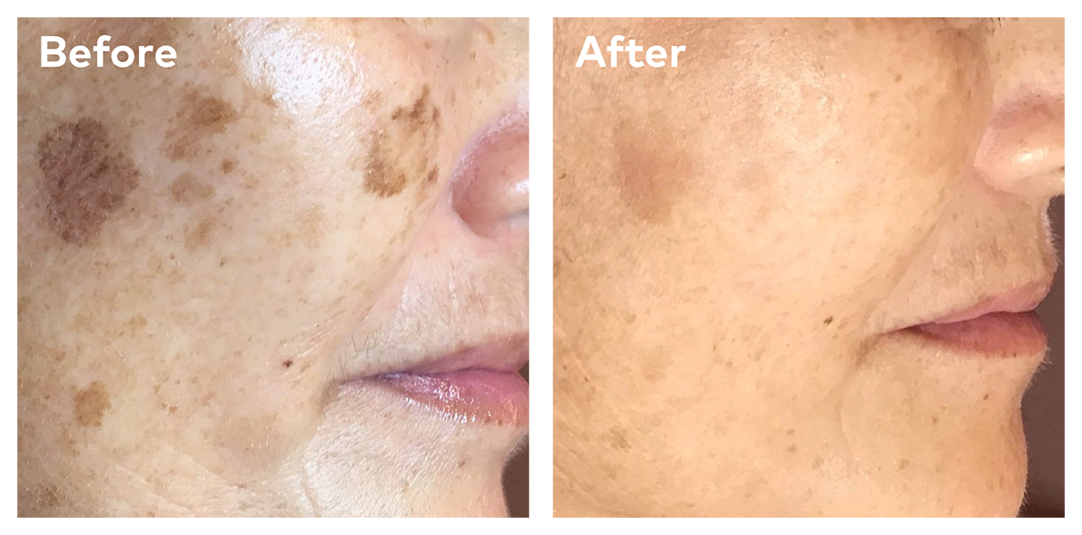 Caci pigmentation before and after