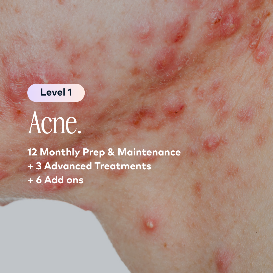 Acne Treatment Plan Level 1 | Caci Clinic