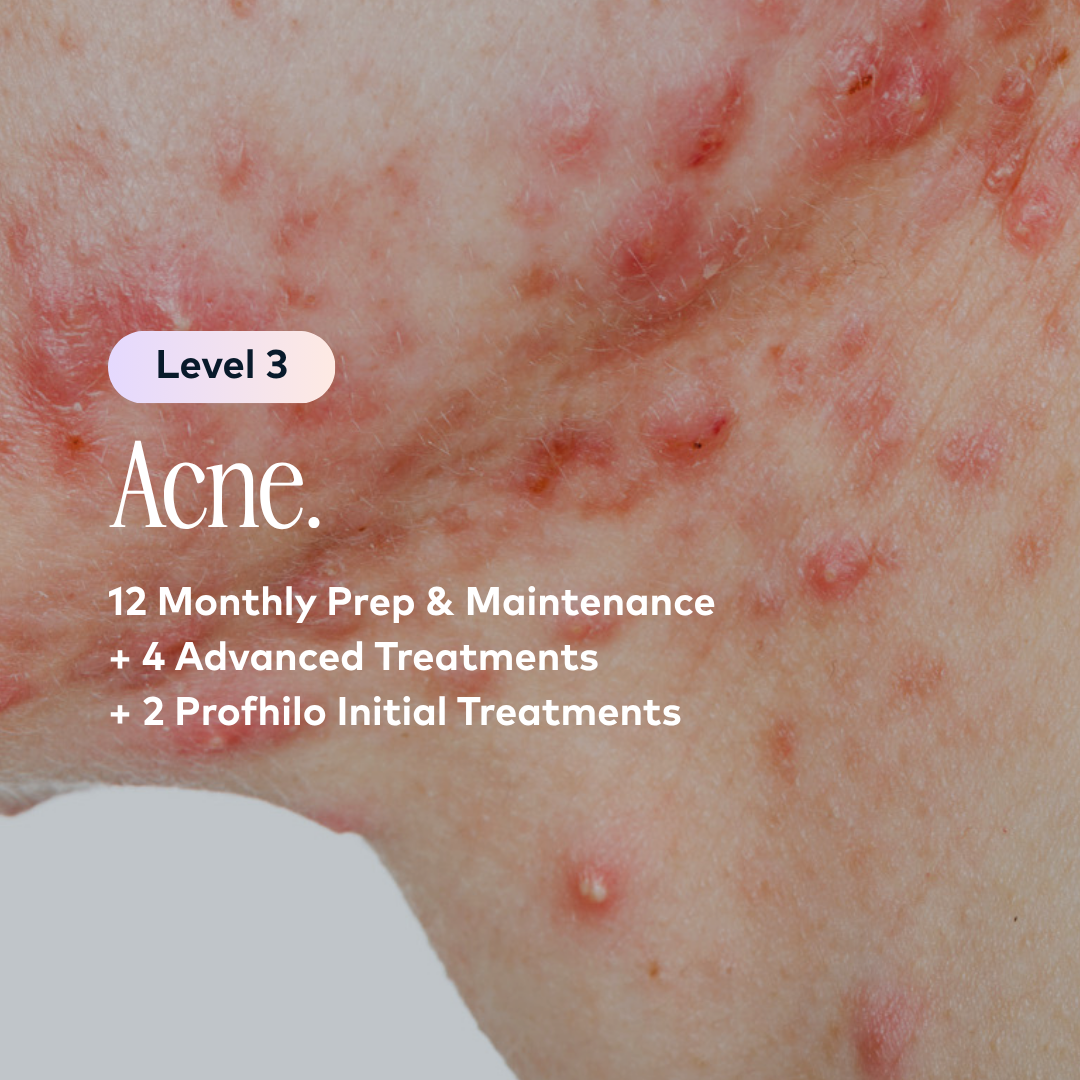Acne Level 3 Plan