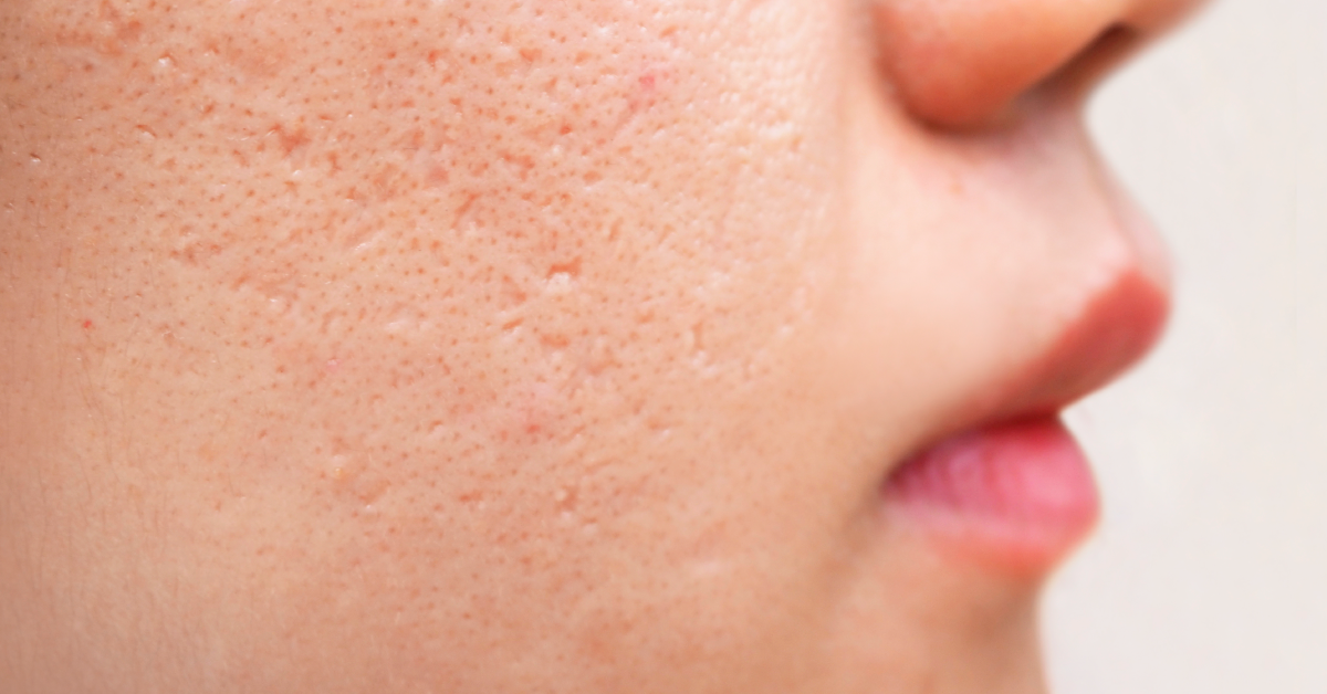 AcneScars.png__PID:024175e6-6022-4a46-a2f0-c03915b16d6c