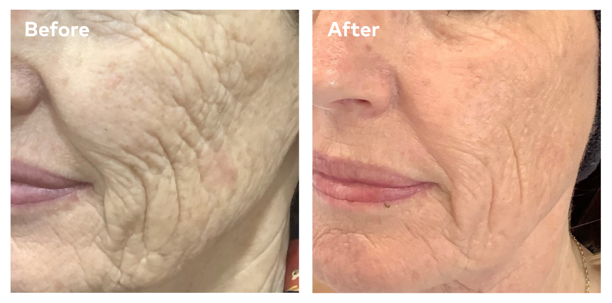 Caci Age Well before and after