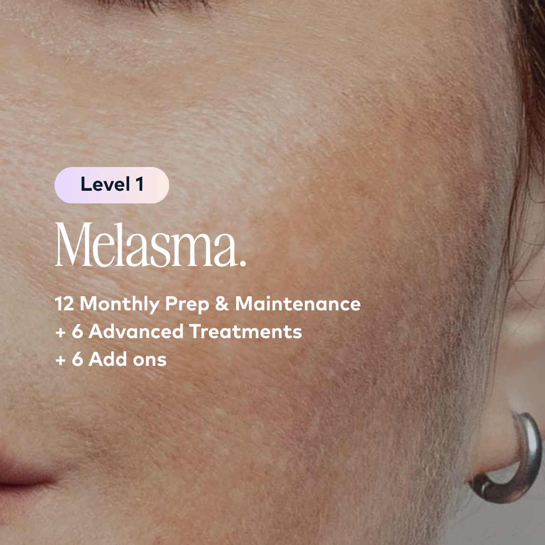 Melasma Level 1