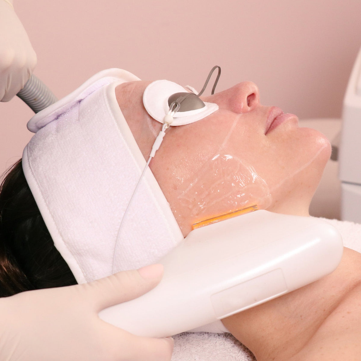 Photo Rejuvenation treatment at Caci