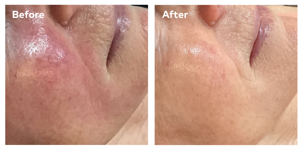 Caci redness before and after