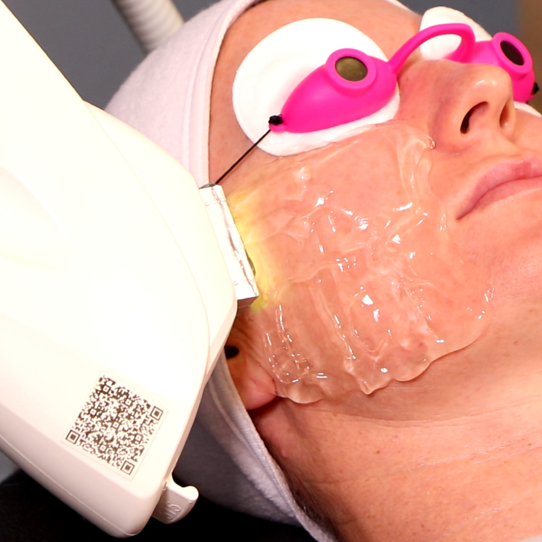 Laser Facial Treatments laser-facial-treatments